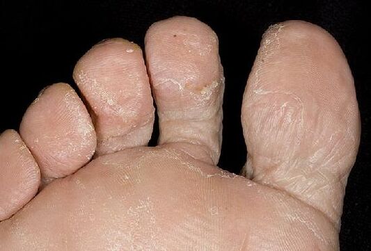 Prejavy plesňovej infekcie na nohách