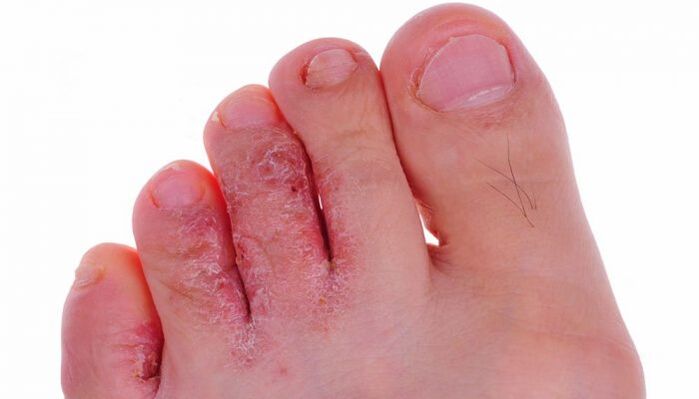 plesňová infekcia kože prstov na nohách