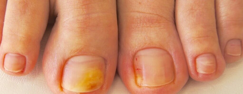 Počiatočná fáza onychomykózy - žltnutie nechtov na nohách