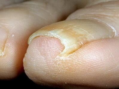 Vzhľad nechtov na nohách infikovaných hubou